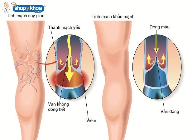 nhung dieu can biet ve suy tinh mach