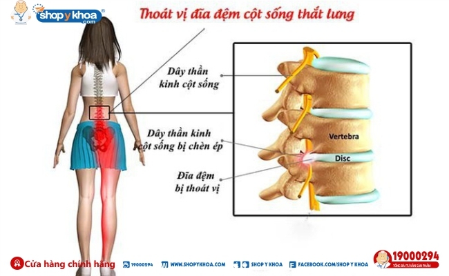 thoat vi dia dem gay dau don nhu the nao